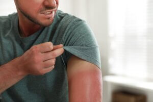 Man with sunburned skin at home, closeup signs of skin cancer